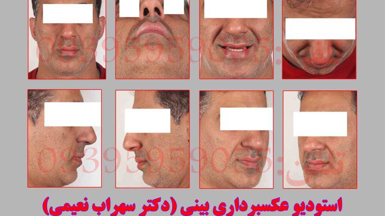 آتلیه پزشکی دکترنعیمی جهت عکاسی قبل از عمل جراحی زیبایی(عمل بینی{دماغ}عمل گونه،دهان و لثه و…)