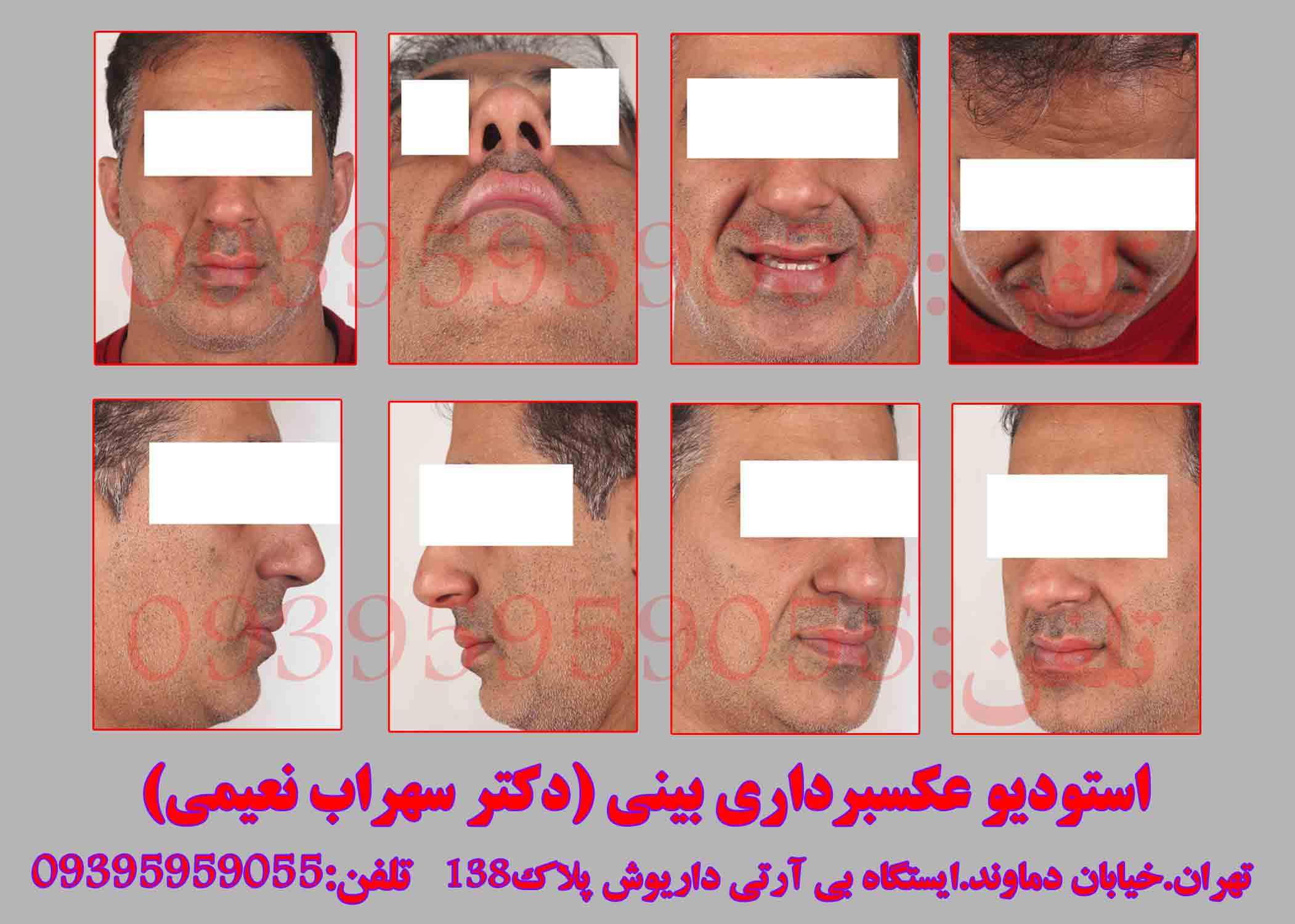آتلیه پزشکی دکترنعیمی جهت عکاسی قبل از عمل جراحی زیبایی(عمل بینی{دماغ}عمل گونه،دهان و لثه و…)